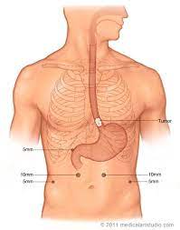 Where are the incisions made for an esophagectomy? Ivor Lewis Esophagectomy Stanford Health Care