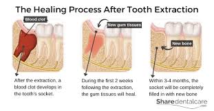 Image result for Post-Tooth Extraction Bleeding