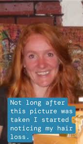 💙unVAILing the VAIL for Alopecia Awareness Month: My Journey💙 At the age  of 9, my mom noticed a bald spot above my ear. Thankfully, it grew back  quickly, and I didn't experience