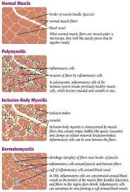 Inflammatory Myopathies Myositis Myositis Polymyositis Dermatomyositis Awareness