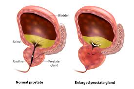 In fact, most people don't even know what it does. Benign Prostatic Hyperplasia Men S Health A Z Canadian Men S Health Foundation