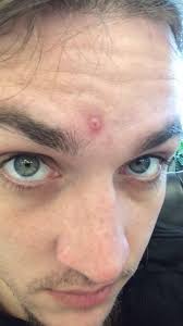 The ultraviolet radiation or uv rays given off by the sun can mutate skin cells and turn them cancerous. Found Out Today I Ve Got Squamous Cell Carcinoma Skin Cancer If A Zit Won T Heal Don T Wait Call A Dermatologist Pics