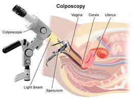 Image result for Colposcopy Findings