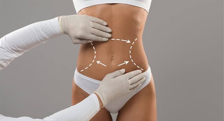 Extended Tummy Tuck in Turkey - Esteworld