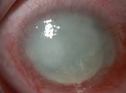Image result for Keratitis