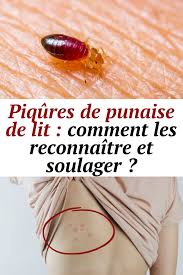 Traitement bouton punaise de lit. Piqures De Punaise De Lit Comment Les Reconnaitre Et Soulager En 2021 Punaises De Lit Piqure Piqure De Puce