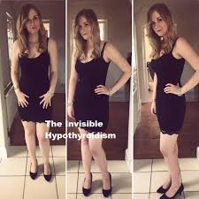 How I Lost The Weight I Gained From Hypothyroidism Hypothyroidism Thyroid Problems Hypothyroidism Symptoms