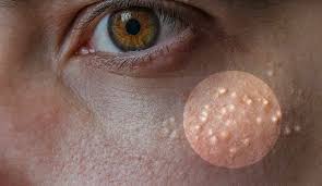 Do You Have White Raised Bumps On Your Skin That Do Not Disappear They Aren T Itchy And They Are N Small Bumps On Forehead Forehead Acne Pimples On Forehead