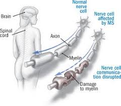 It affects more than 25,000 people in australia and is 3 times more common in women than in men. Multiple Sclerosis Guide Causes Symptoms And Treatment Options