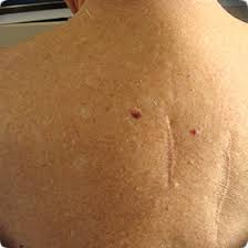 Freckle on palm of hand melanoma. Melanoma Skin Cancer Melanoma Cancer Skin Melanoma Melanoma Moles