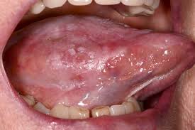 Image result for dental cancer