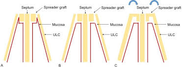 They are placed between the upper lateral cartilage and septum. Spreader Graft Placement Location Location Location Journal Of Plastic Reconstructive Aesthetic Surgery