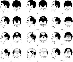 How Bald Are You Based On The Norwood Scale