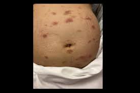 Image result for pruritic urticarial papules and plaques of pregnancy
