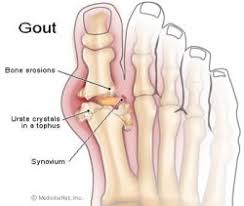 See more of cegah benjolan & bengkok pada ibu jari kaki on facebook. Gout Apabila Kristal Menyerang Sendi Dr Ahmad Mahyuddin The Malaysian Medical Gazette