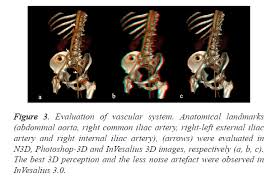 Invesalius generates 3d medical imaging reconstructions based on a sequence of 2d dicom files acquired with ct or mri equipments. Comparison Of 3d Reformat Computed Tomography Images Using Different Softwares Do They Have An Incremental Value In 3d Imaging