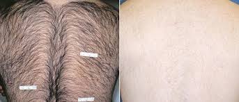 Maybe you would like to learn more about one of these? Laser Hair Removal Dr Julia Sabetta Greenwich Ct Cosmetic Surgeon