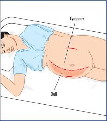 Maybe you would like to learn more about one of these? Ascites British Journal Of Hospital Medicine