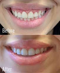 This solution is cheaper than surgery and less intrusive. Gummy Smile Shrewsbury Nj Plastic Surgery Center