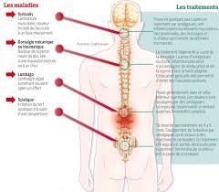 De taille plus faible, le grand rond et les rhomboïdes complètent le tableau, sans oublier les muscles placés en bas du dos, notamment les érecteurs du rachis. Mal De Dos La Posture Souvent Coupable