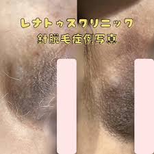 介護脱毛の画像