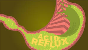 Several other substances that are occasionally sold as lsd (notably the nbome series of chemicals) are not active if swallowed. Your Burning Chest How To Stop Acid Reflux And Gerd Unc Health Talk