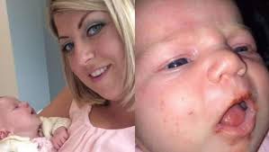 Kiss almost killed my baby': Mum's warning after newborn catches herpes  simplex virus