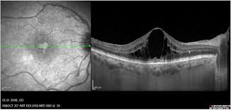 Retina Ve Vitreus Hastaliklari Ankara Goz Hastaliklari Uzmani Prof Dr A Kaan Gunduz