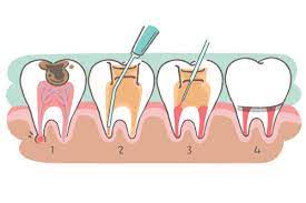 Pulpotomies And Nerve Therapy For Baby Teeth Waban Dental Group