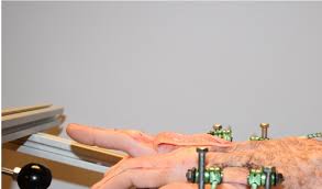 Image result for Elson Extensor Tendon Test