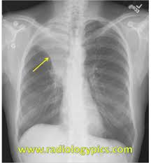 The Golden S Sign Right Upper Lobe Collapse Diagnostic Imaging Radiology Imaging Respiratory Care