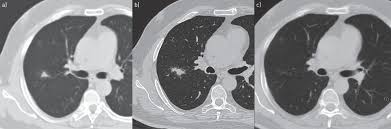 If your cat does spend a lot of time exploring the great outdoors, there are some concerns i'm honestly not sure how much longer she has. Slow Growing Lung Cancer As An Emerging Entity From Screening To Clinical Management European Respiratory Society