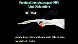 Image result for DIP Dislocation