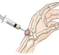Ganglion Cyst of the Wrist and Hand - OrthoInfo - AAOS