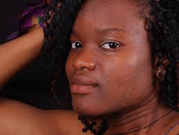 Simple tips to get rid of hyperpigmentation. This May Be The Best Skin Treatment For People Of Color With Dark Marks