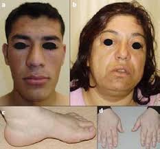 Image result for Acromegaly