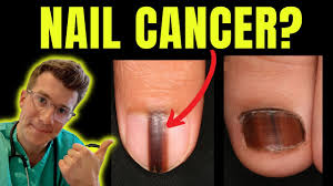 Image result for Acral lentiginous melanoma nail