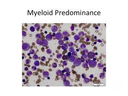 Dba causes low red blood cell counts (anemia), without substantially affecting the other blood components (the platelets and the white blood cells), which are usually normal. Diamond Blackfan Anemia Aspirate