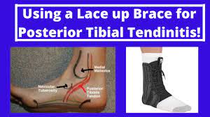 Will Ankle Brace Help Posterior Tibial Tendonitis