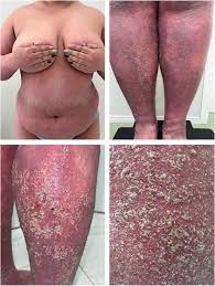 Image result for Pustular Psoriasis