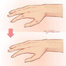 Get their location and phone number here. 28 Best Wart Removal In Selangor Price Guide Reviews