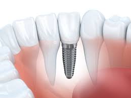 How long does it take to get a tooth pulled at the dentist. How Long After Tooth Extraction Can I Get A Dental Implant