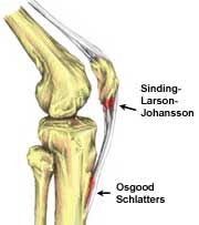 Sinding-Larsen and Johansson syndrome - Wikipedia