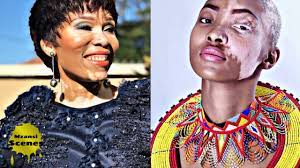 Disabled celebrities in south africa. South African Celebrities Suffering From Vitiligo South Africa Rich And Famous