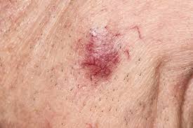 Image result for Merkel Cell Carcinoma