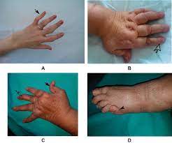 Diagnostic Challenges And Management Update In Rheumatoid Arthritis Intechopen