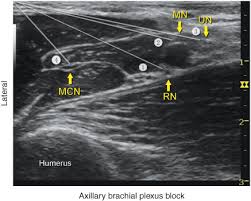 Image result for Axillary Nerve Block