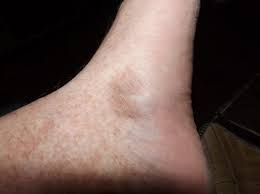 Image result for liver spots on legs