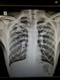Rt Upper Lobe Consolidation Multiple Granulomas Old Kocks With Superadded Infection Medecine