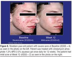 A New Once Daily Optimized Fixed Combination Of Clindamycin Phosphate 1 2 And Low Concentration Benzoyl Peroxide 2 5 Gel For The Treatment Of Moderate To Severe Acne Jcad The Journal Of Clinical And Aesthetic Dermatology